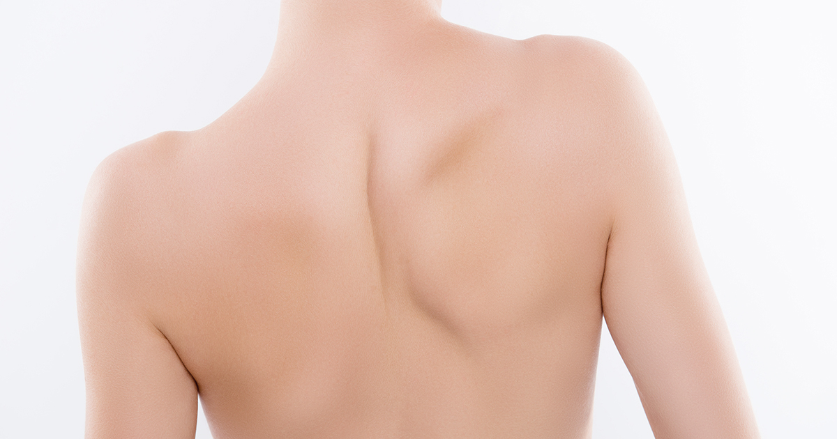 SCOLIOSIS SHOULD NOT BE OVERLOOKED IT MIGHT HAPPEN TO ALL AGE GROUPS